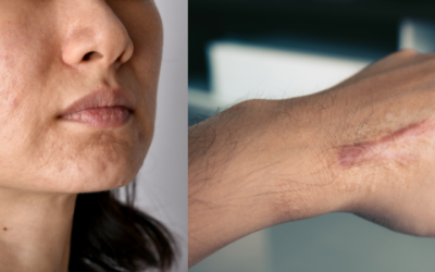 Cicatrice : nos astuces pour une bonne cicatrisation de la peau