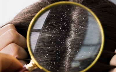 Les pellicules : pourquoi et comment les éliminer ?